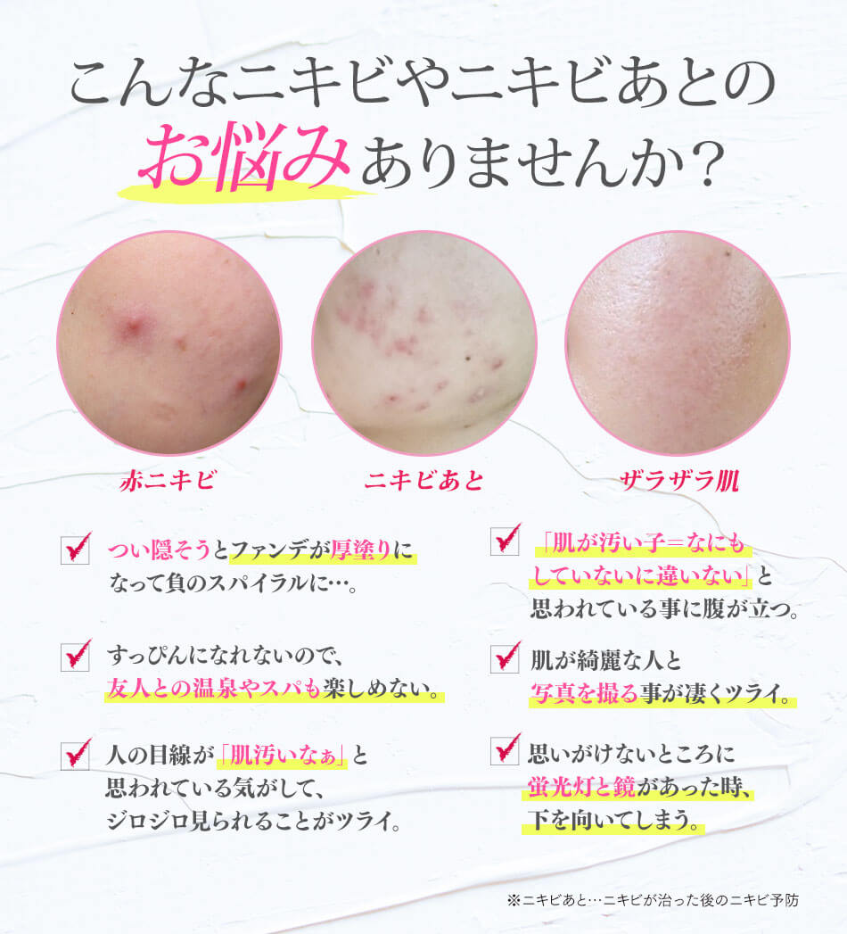 こんなニキビやニキビ跡のお悩みありませんか？赤ニキビ・ニキビ跡・クレーター肌。その1、つい隠そうをファンデが厚塗りになって負のスパイラルに…。その2すっぴんになれないので友人との温泉やスパも楽しめない。その3、人の目線が「肌汚いなぁ」と思われている気がして、辛い。その4肌がきれいな人と写真を撮る事が凄く辛い。