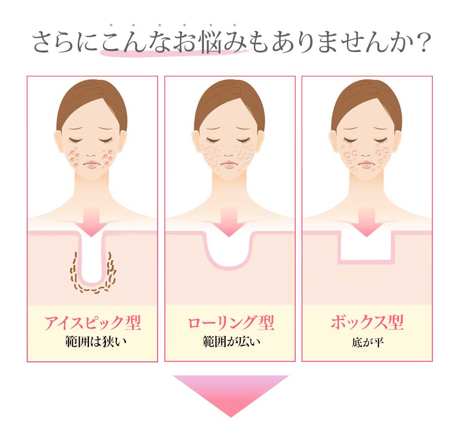 クレーター肌の種類。さらにこんなお悩みもありませんか？アイスピック型（範囲は狭い）ローリング型（範囲が広い）ボックス型（底が平）